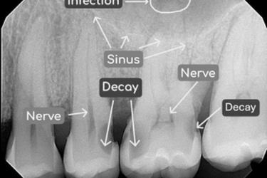 Radiograph displaying deep cavities near the nerve, with an infection at the root tip of one tooth.