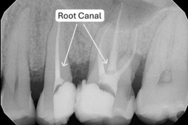 Root canal treatment completed — canals are filled and sealed to prevent further infection.