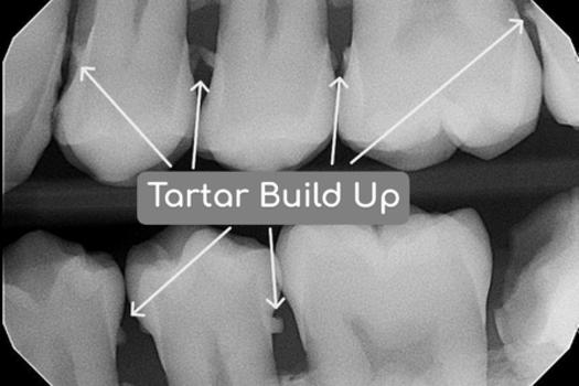 This X-ray shows hardened tartar buildup between the teeth. If left untreated, it can irritate the gums and eventually lead to gum disease and bone loss