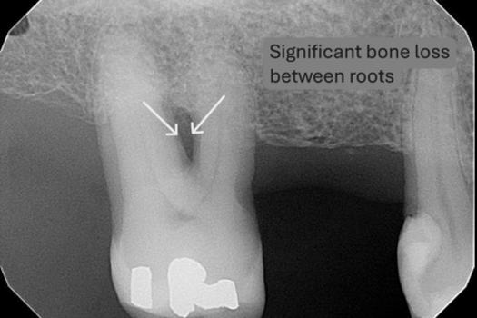 This X-ray shows significant bone loss around the upper molar. The bone that normally supports the tooth has receded, which is a sign of advanced gum disease and, if left untreated, can lead to tooth mobility or even tooth loss.