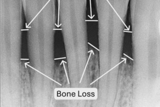 This X-ray shows moderate bone loss around the lower front teeth. This is a sign of gum disease, and if left untreated, it could affect the stability of these teeth over time.