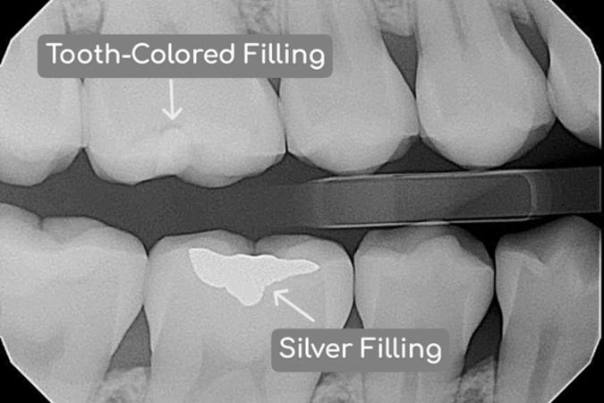 X-ray showing tooth-colored and silver fillings—two common materials used to restore teeth.