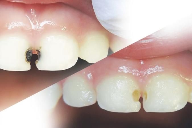 The dark spot shows where the cavity has been stopped from getting worse.
