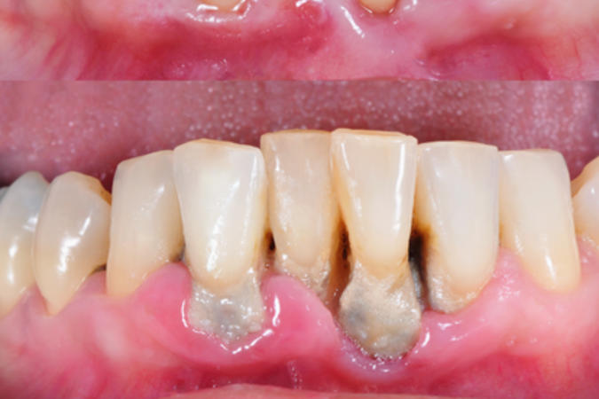 See the difference a professional dental cleaning can make! Say goodbye to tartar buildup and hello to a healthier, brighter smile.