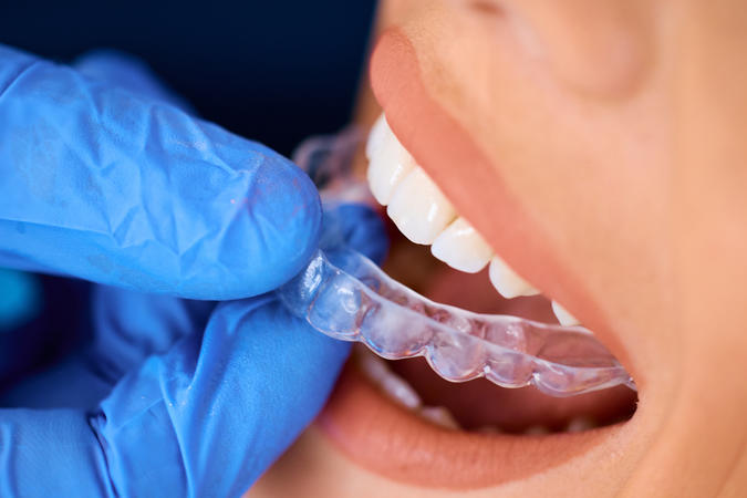 A night guard creates a protective barrier between the teeth, helping to prevent wear and jaw discomfort caused by nighttime grinding.