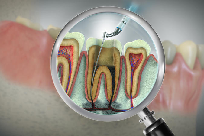 An advanced endodontic instrument used to gently remove infected tooth tissue.