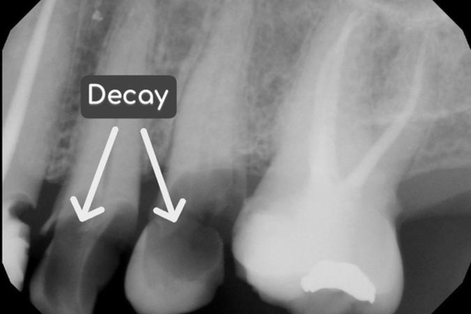 This X-ray show how badly the teeth are decayed — extraction will be the best option.