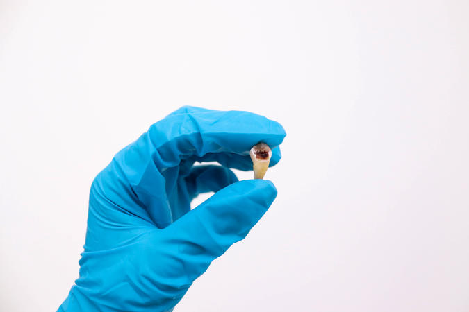 This tooth was too damaged to save, so extraction was necessary.